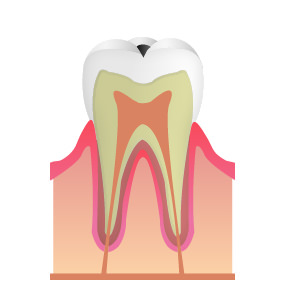 立川の歯医者・歯科、くどう歯科クリニック(審美歯科・マウスピース矯正)の虫歯治療(むし歯)エナメルう蝕（C1）