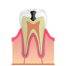 立川の歯医者・歯科、くどう歯科クリニック(審美歯科・マウスピース矯正)の虫歯治療(むし歯)象牙質う蝕（C2）