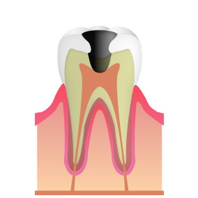 立川の歯医者・歯科、くどう歯科クリニック(審美歯科・マウスピース矯正)の神経まで達したむし歯（C3）