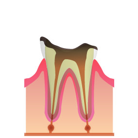 立川の歯医者・歯科、くどう歯科クリニック(審美歯科・マウスピース矯正)の残痕状態のむし歯（C4）