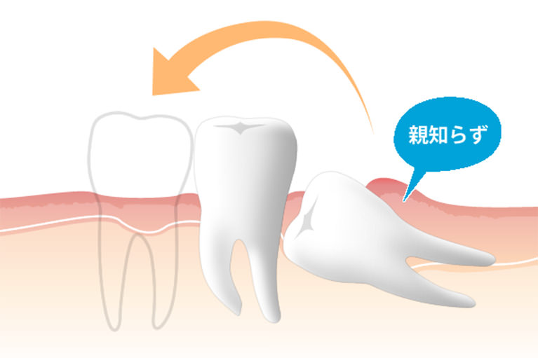 親知らずの移植（歯牙移植）
