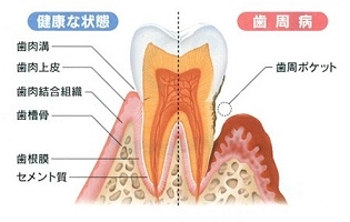 歯周病画像くどう歯科クリニック